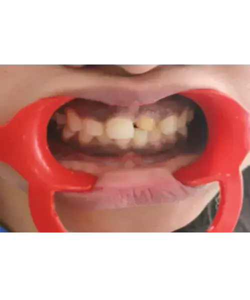 Smile transformation 4 — before treatment