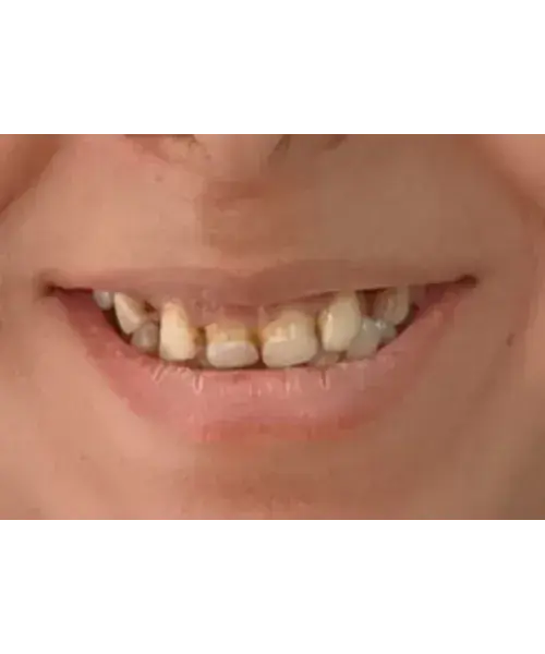 Smile transformation 6 — before treatment