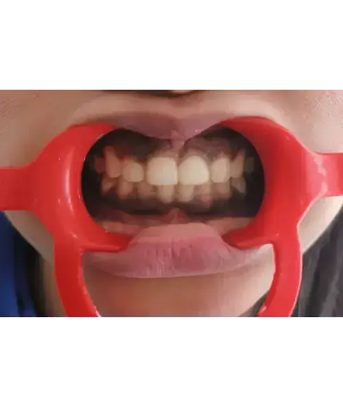 Smile transformation 4 — after treatment