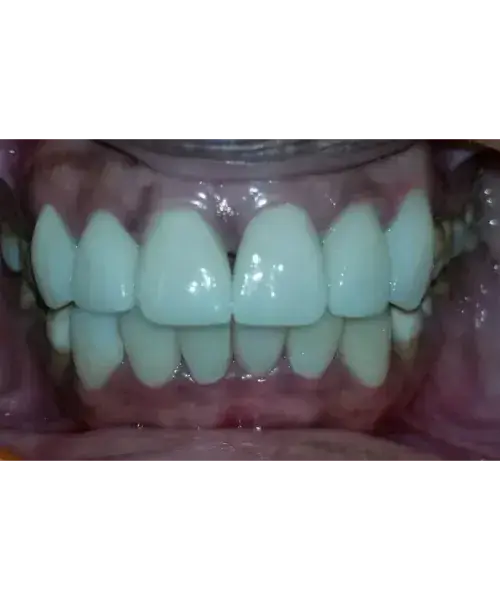 Smile transformation 5 — after treatment