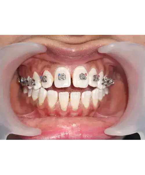 Smile transformation 7 — after treatment