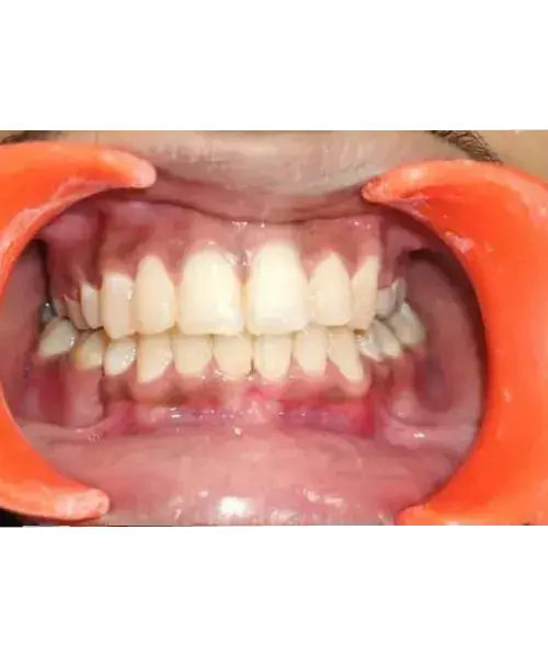 Smile transformation 8 — after treatment